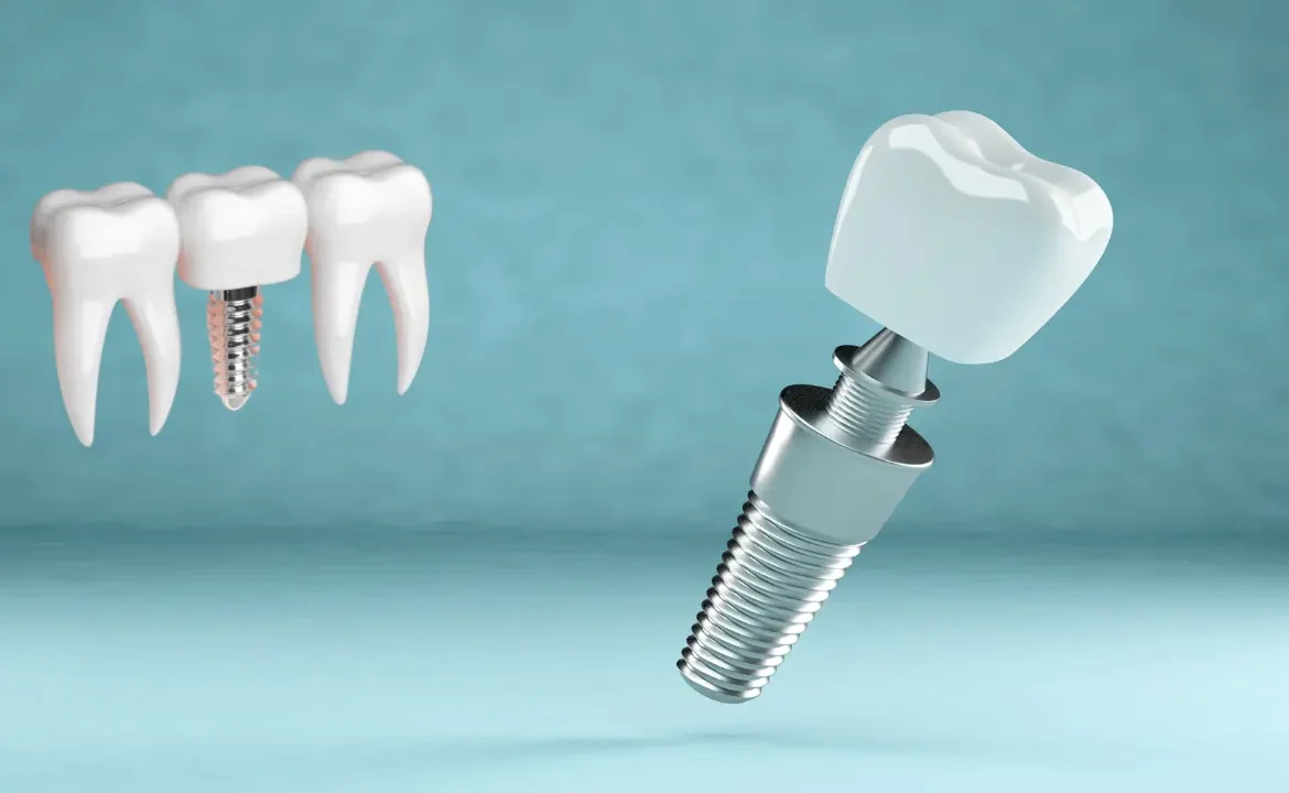 four Teeths for Dental Implants in Dubai